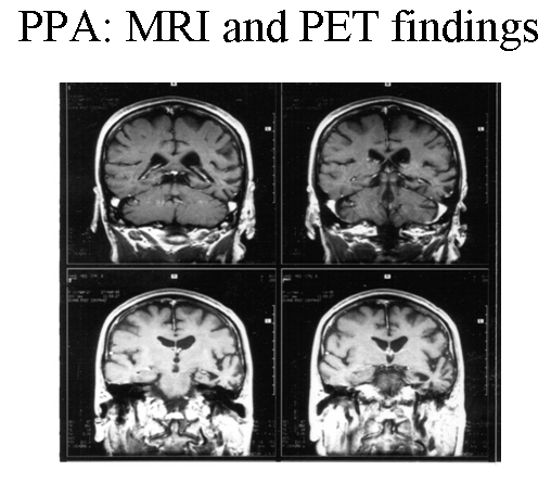 Patient with progressive nonfluent aphasia. MRI s...